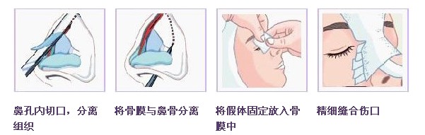 隆鼻.jpg